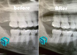 Dr Ash Traveling periodontics, osseous surgery