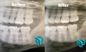 Dr Ash Traveling periodontics, osseous surgery