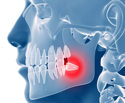 WISDOM TEETH REMOVAL – Perio Surgery